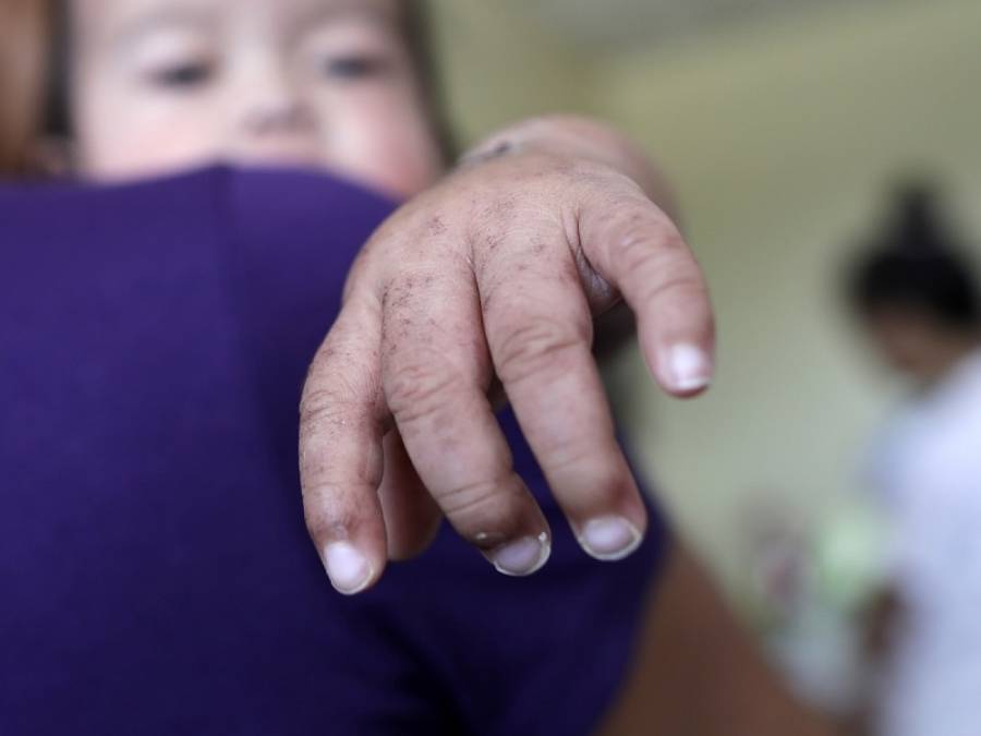 «Καμπανάκι» ΠΟΥ: 140.000 θάνατοι από ιλαρά το 2018