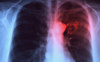 Η Φυματίωση αποτελεί τη 2η αιτία θανάτου από λοιμώδες αίτιο