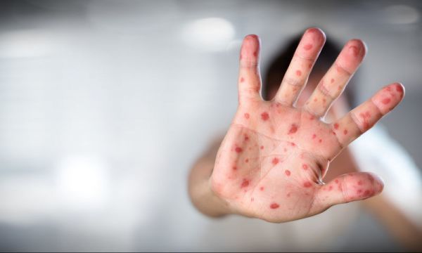 Ιταλία: Βρέφος πέθανε από επιπλοκές της ιλαράς