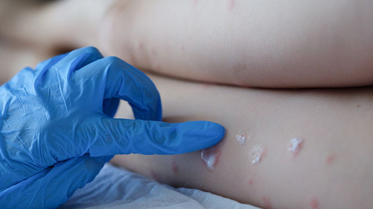 Ευλογιά των πιθήκων: Στα 80 τα επιβεβαιωμένα κρούσματα στην Ελλάδα