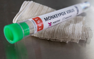 Ευλογιά των πιθήκων: Στα 82 τα επιβεβαιωμένα κρούσματα στην Ελλάδα