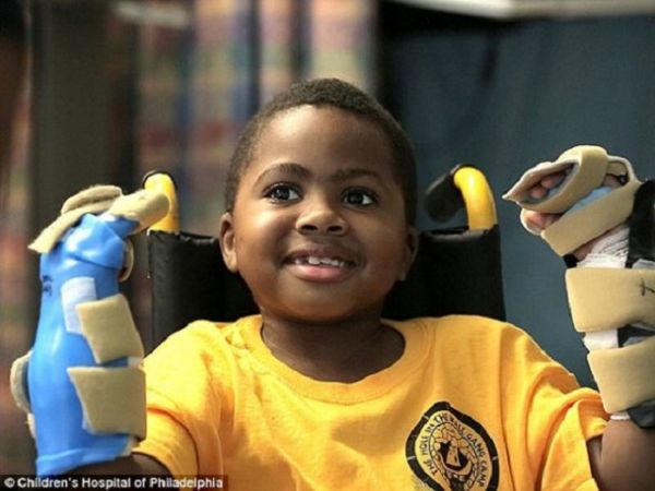 Για πρώτη φορά μεταμόσχευση και των δύο χεριών σε παιδί (video)