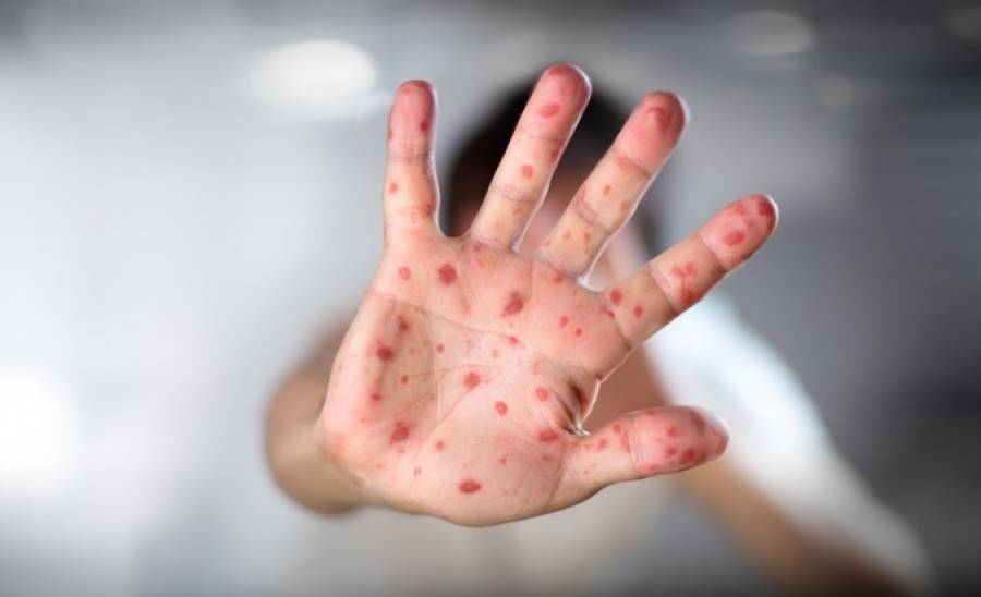 Για 3.103 κρούσματα ιλαράς κάνει λόγο το ΚΕΕΛΠΝΟ